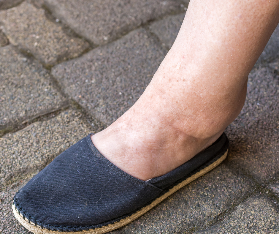 Izplatītākie mīti par kāju tūsku vasarā: farmaceites ieteikumi