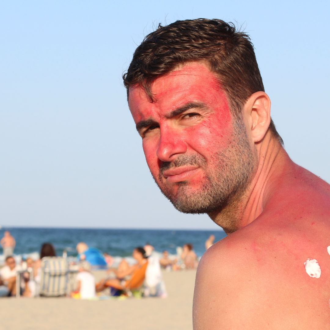 Atvaļinājumu laiks: kā rīkoties saules apdeguma gadījumā?